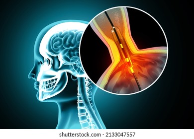 Atherosclerosis Stroke.A Blood Clot In The Vessels Of The Human Brain.Balloon Angioplasty Procedure With Stent In Vein.3d Illustration