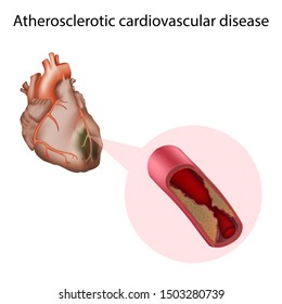 Atherosclerotic Cardiovascular Disease. Medical Anatomy Illustration.