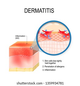 Atopic Dermatitis (atopic Eczema). Cross-section Of Human Skin With Dermatitis. Close-up Of Skin Cells, And Penetration Of Allergens. Illustration For Medical, Biological, And Educational Use