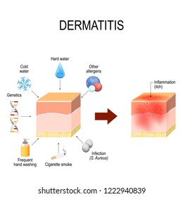 Atopic Dermatitis Atopic Eczema Healthy Skin Stock Illustration ...