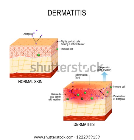 Atopic dermatitis (atopic eczema). Healthy skin and cross-section of human skin with dermatitis. showing changes and differences. illustration for medical and educational use