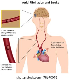 Atrial Fibrillation Causing Stroke