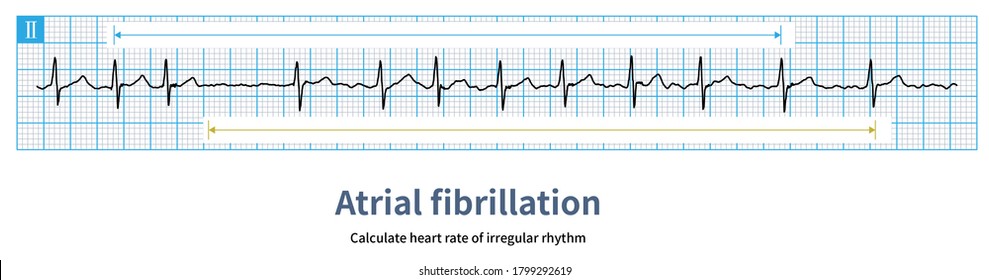 774 Fibrillation ventricular Images, Stock Photos & Vectors | Shutterstock