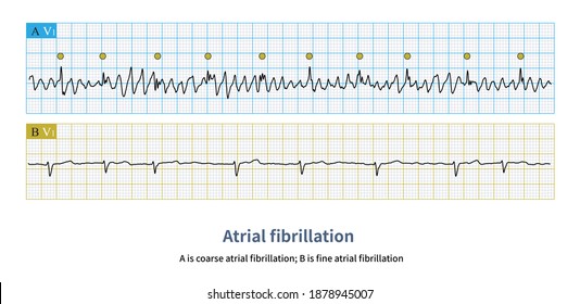 255 Atrial Flutter Images, Stock Photos & Vectors 