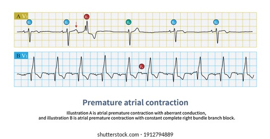 168 Aberrant conduction Images, Stock Photos & Vectors | Shutterstock