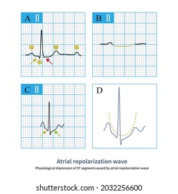 63 Pathological q wave Images, Stock Photos & Vectors | Shutterstock