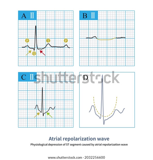 Atrial Repolarization Wave Can Cause St Stock Illustration 2032256600 ...