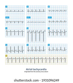 Atrial Tachycardia Originated From The Ostium Of Coronary Sinus, With Inverted P Wave In Inferior Lead, And Positive-negative Biphasic Or Negative P Wave In V1 Lead.