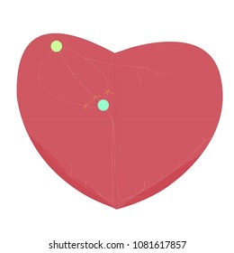 Atrioventricular Block (AV Block) Is A Type Of Heart Block