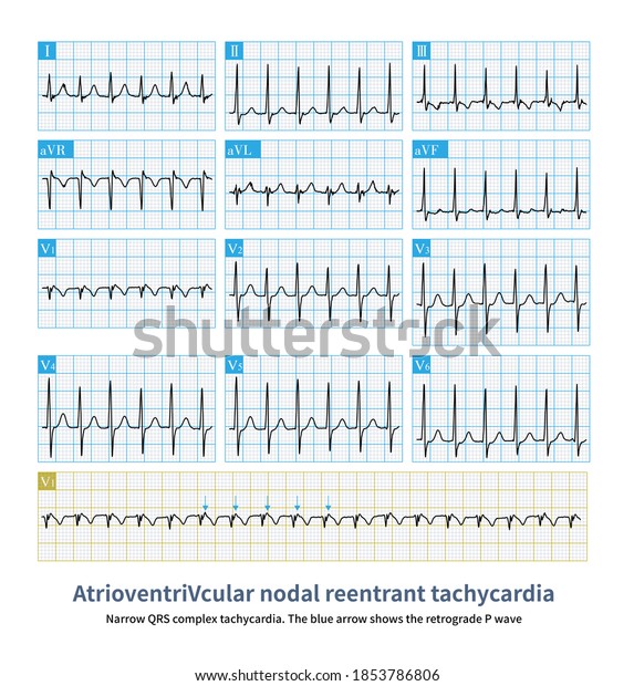 Atrioventricular Node Reentrant Tachycardia Usually Narrow Stock ...