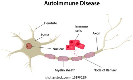 Autoimmune Disease