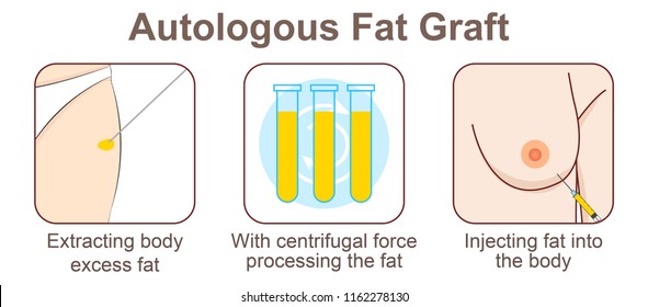 Autologous Fat Transfer