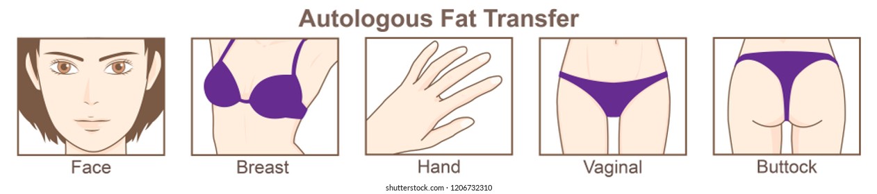 Autologous Fat Transfer