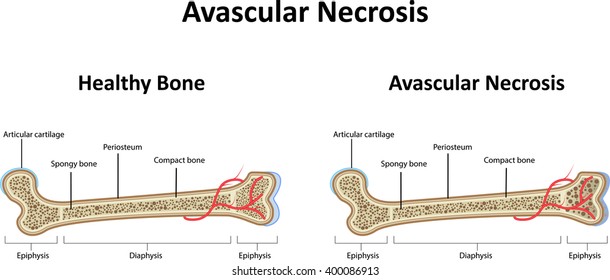 Avascular Necrosis Illustration