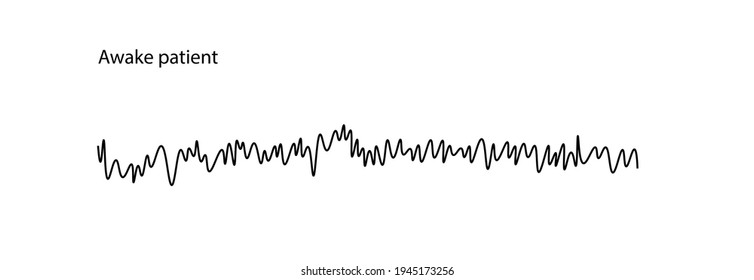 Awake patient EEG (electroencephalography) waveform
