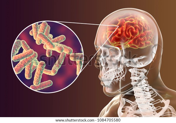 Bacterial Brain Infection Medical Concept Meningitis Stock Illustration ...