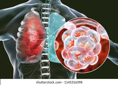 20,275 Lung Bacteria Images, Stock Photos & Vectors | Shutterstock