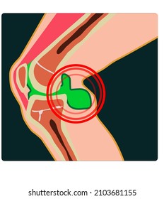 Baker Cyst Trauma, Knee Medical Illustration