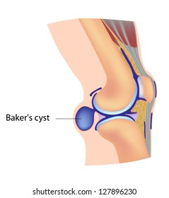 Baker's Cyst