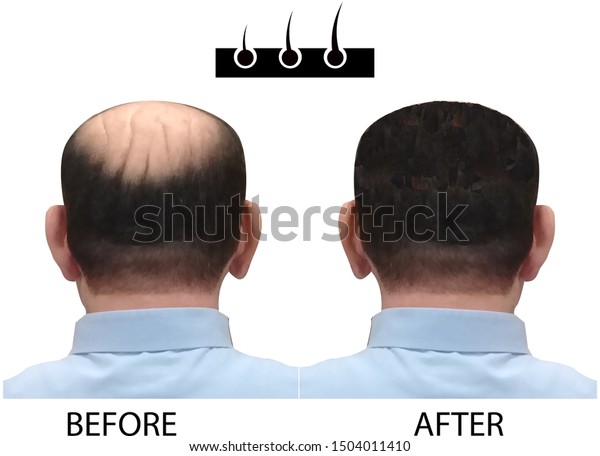 Bald Man Before After Hair Transplantation のイラスト素材