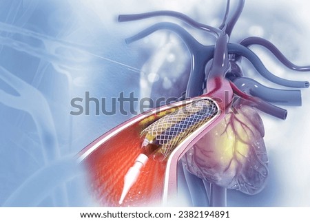 Balloon angioplasty procedure with stent in vein.3d illustration Stock foto © 