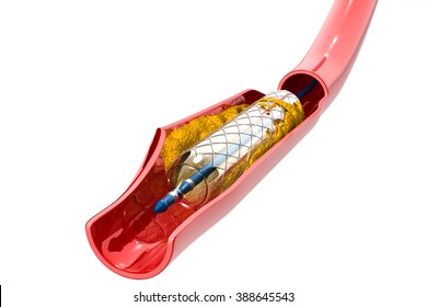 Balloon Expandable Stent. Anatomical Concept