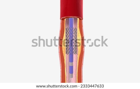 The balloon expends, widening the wire mesh stent and the artery 3D rendering