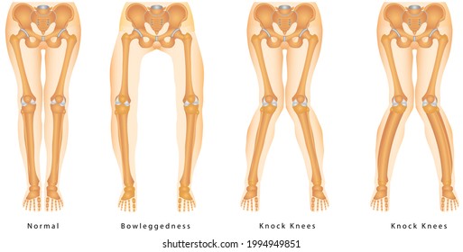 Bandy-legs. Shape Of The Legs - Genu Varum, Genu Valgum - A Physical Legs Deformity, Bowing Of The Leg In Relation To The Thigh. Knock Knees - Valgus, Is A Physical Deformity