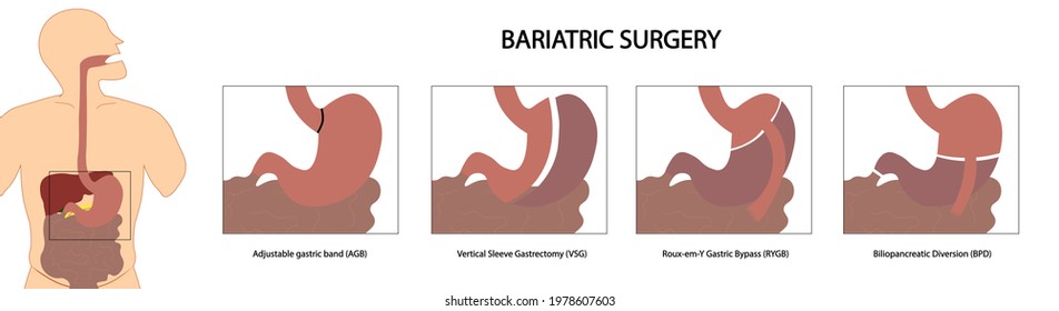 Bariatric Surgery - Different Types Of Bariatric Procedures