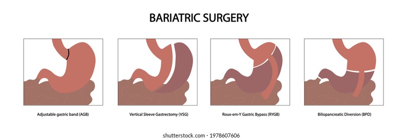 Bariatric Surgery - Different Types Of Bariatric Procedures