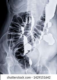 Barium Enema Image Or BE Left Lateral Decubitus View  Showing Air And Barium Sulphate In Colon Or Large Intestine.  