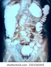 Barium enema study image or x-ray image of large intestine .