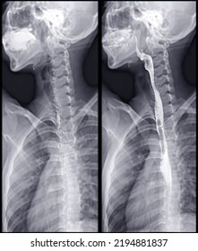 Barium Swallow Study Test Diagnose Barrett's GI Tract Exam GERD Ulcers Series Difficulty Pharynx Procedure UGI Throat Bowel Therapy By Fluoroscopy Devices.