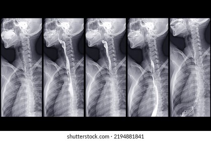 Barium Swallow Study Test Diagnose Barrett's GI Tract Exam GERD Ulcers Series Difficulty Pharynx Procedure UGI Throat Bowel Therapy By Fluoroscopy Devices.