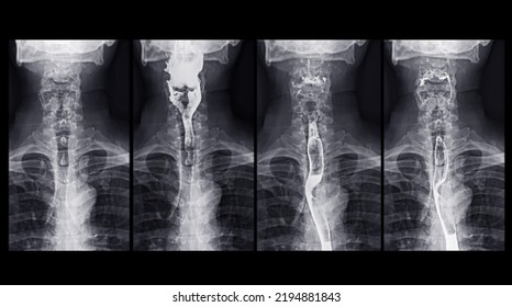 Barium Swallow Study Test Diagnose Barrett's GI Tract Exam GERD Ulcers Series Difficulty Pharynx Procedure UGI Throat Bowel Therapy By Fluoroscopy Devices.