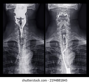 Barium Swallow Study Test Diagnose Barrett's GI Tract Exam GERD Ulcers Series Difficulty Pharynx Procedure UGI Throat Bowel Therapy By Fluoroscopy Devices.