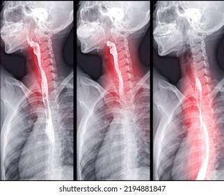 Barium Swallow Study Test Diagnose Barrett's GI Tract Exam GERD Ulcers Series Difficulty Pharynx Procedure UGI Throat Bowel Therapy By Fluoroscopy Devices.