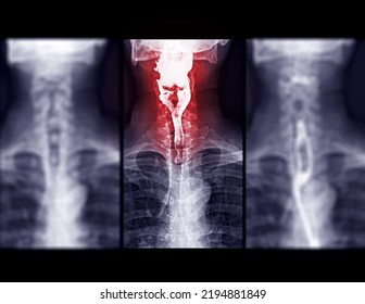 Barium Swallow Study Test Diagnose Barrett's GI Tract Exam GERD Ulcers Series Difficulty Pharynx Procedure UGI Throat Bowel Therapy By Fluoroscopy Devices.