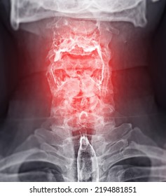 Barium Swallow Study Test Diagnose Barrett's GI Tract Exam GERD Ulcers Series Difficulty Pharynx Procedure UGI Throat Bowel Therapy By Fluoroscopy Devices.
