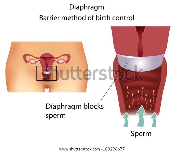 Barrier contraceptive method- Diaphragm.\
Detailed female reproductive\
anatomy.