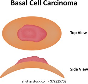 Basal Cell Carcinoma