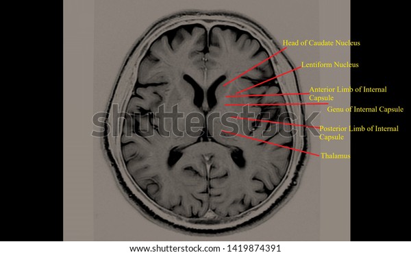 Basal Ganglia Annotated Structures Brain Mri 库存插图1419874391