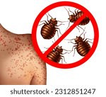Bedbug bites on human skin  or bedbug infestation concept as a magnification close up of parasitic insect pests as a hygiene symbol of bloodsucking parasites with 3D illustration style.