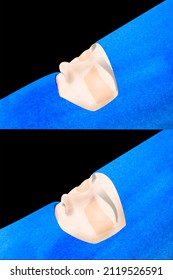  Before: wide and globular nasal tip, as well as the nasal wing. Afterwards: refinement and structuring of the nasal tip and reduction and narrowing of the dorsum and ala of the nose. 