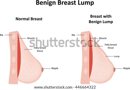 benign breast in lump Black and white girl with juicy pussy