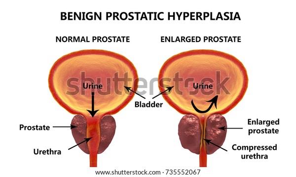 hiperplasia prostática benigna que significa en hindi hiperplasia prostática benigna que significa en hindi