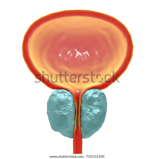 Benign Prostatic Hyperplasia 3d Illustration Showing Stock Illustration ...