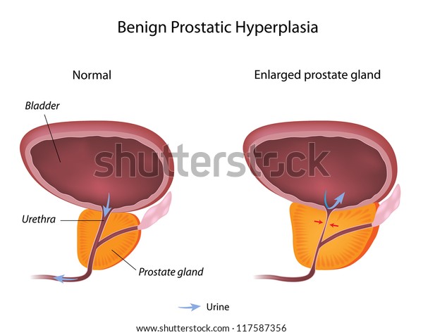 Benign prostatic hyperplasia bph jelentése magyarul » DictZone A…
