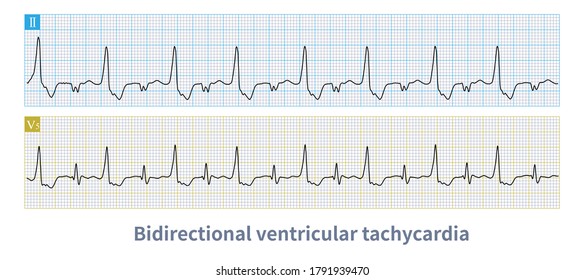 Bidirectional Ventricular Tachycardia Fatal Ventricular Arrhythmia ...