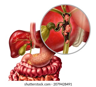 Bile Duct Cancer Or Cholangiocarcinoma With A Gall Bladder And Liver As A Disease Of The Digestive System Represents A Medical Health Concept In Human Organ Anatomy With 3D Illustration Elements.